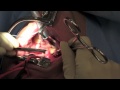 UPPP Sleep Apnea Surgery (Uvulopalatopharyngoplasty)