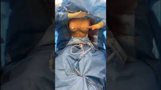 Breast Augmentation With A Hidden Scar Through The Armpit Breast Implant Insertion Technique