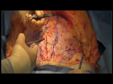Tummy Tuck (abdominoplasty) surgery video