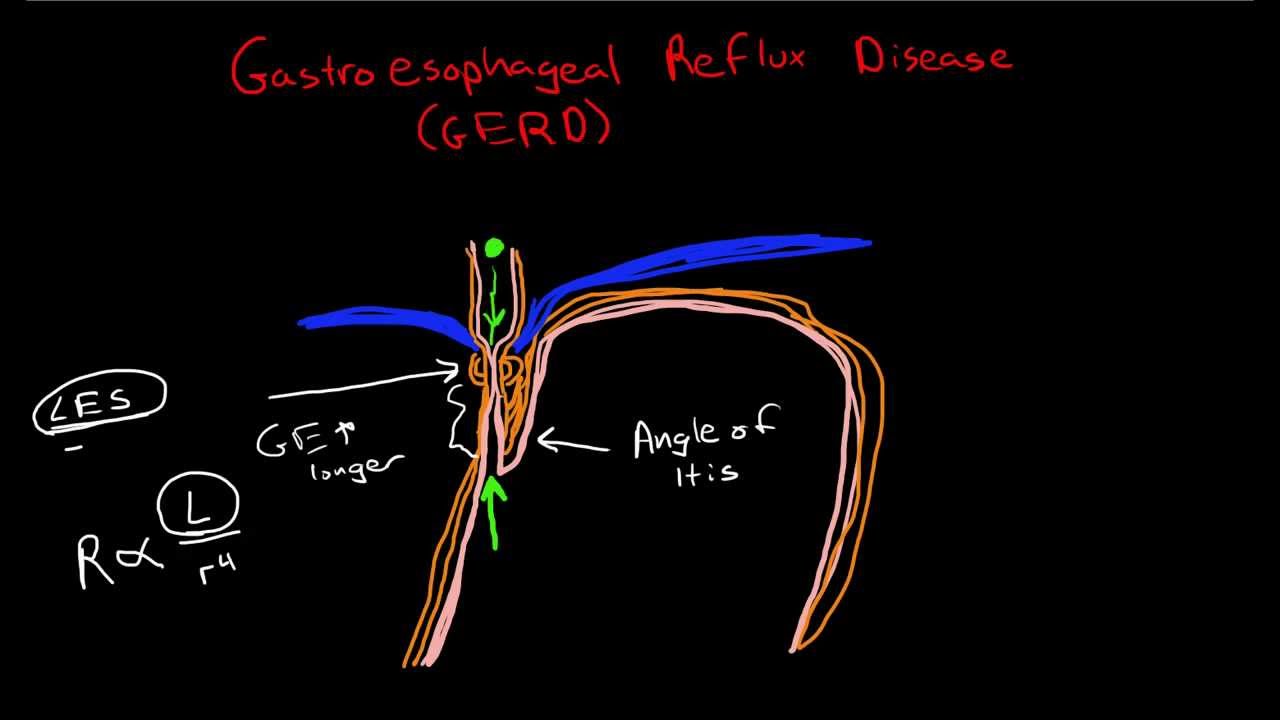 Pathophysiology of Gastroesophageal Reflux Disease (GERD) - YouTube