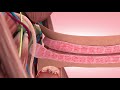 Peyronie's Disease treatment Animation, Steinberg Urology Montreal