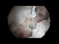 Labral Repair