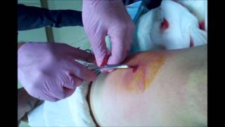 clomid therapy clomid therapy