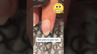 Red And Damaged Nails How To Save Them