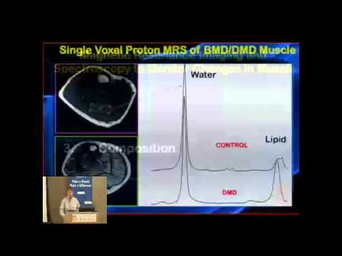 an introduction to oculopharyngeal muscular dystrophy opmd Welcome opmd (oculopharyngeal muscular dystrophy) is one of several types of muscular dystrophy (md) md is a group of genetic, degenerative diseases primarily. an introduction to oculopharyngeal muscular dystrophy opmd Welcome opmd (oculopharyngeal muscular dystrophy) is one of several types of muscular dystrophy (md) md is a group of genetic, degenerative diseases primarily.