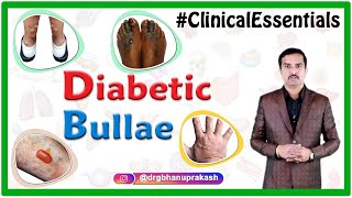 Diabetic Bullae Bullosis Diabeticorum - Clinical Essentials Dr G Bhanu Prakash