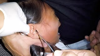 Removing Something Trapped in Girl's Ear . It's STUCK!