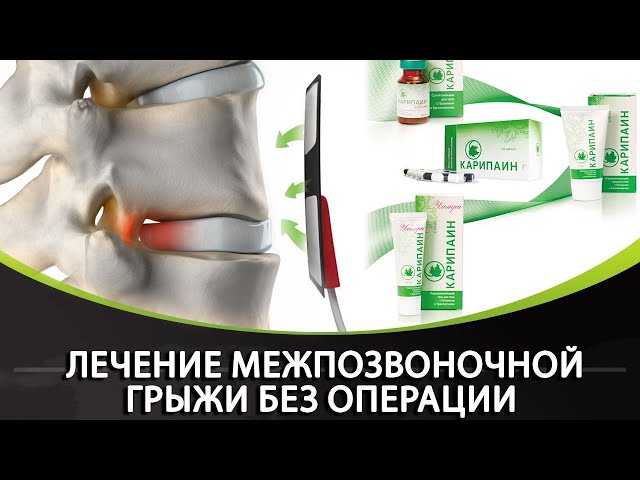 Как в домашних условиях вылечить межпозвоночную грыжу 910