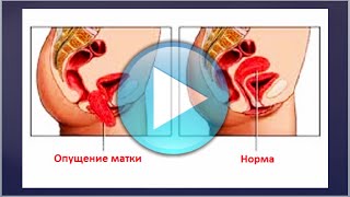 Что применять при выпадении матки?