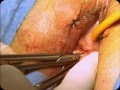 Needleless, the Single Incision TOT sling for Female Incontinence