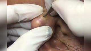 Large Earlobe Cyst Explode-Infections, Mrsa & Straph