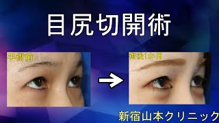 目の形成(目尻切開編)東京新宿の山本クリニック