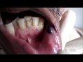 Black Blisters In Mouth