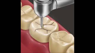 Asmr So Satisfying Caries Removal Animation Dent Al Care Molar Tooth