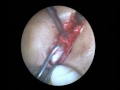 10-11-11-Single Incision Laparoscopy (Cholycystectomy)A