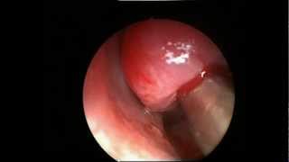 Maxillary Sinus Cyst Removal
