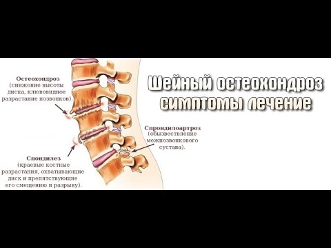 Вода остеохондроз Вода остеохондроз