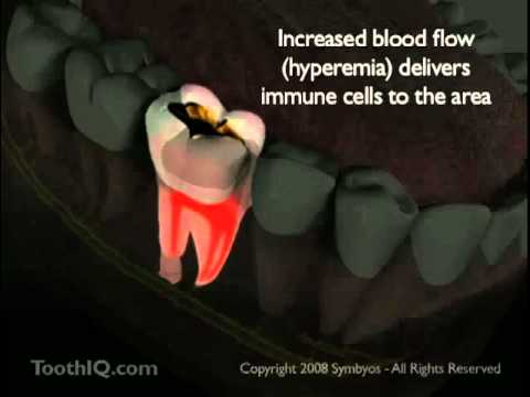 Gums Pus