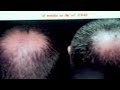 baldness will stop with zx42 baldness will stop with zx42