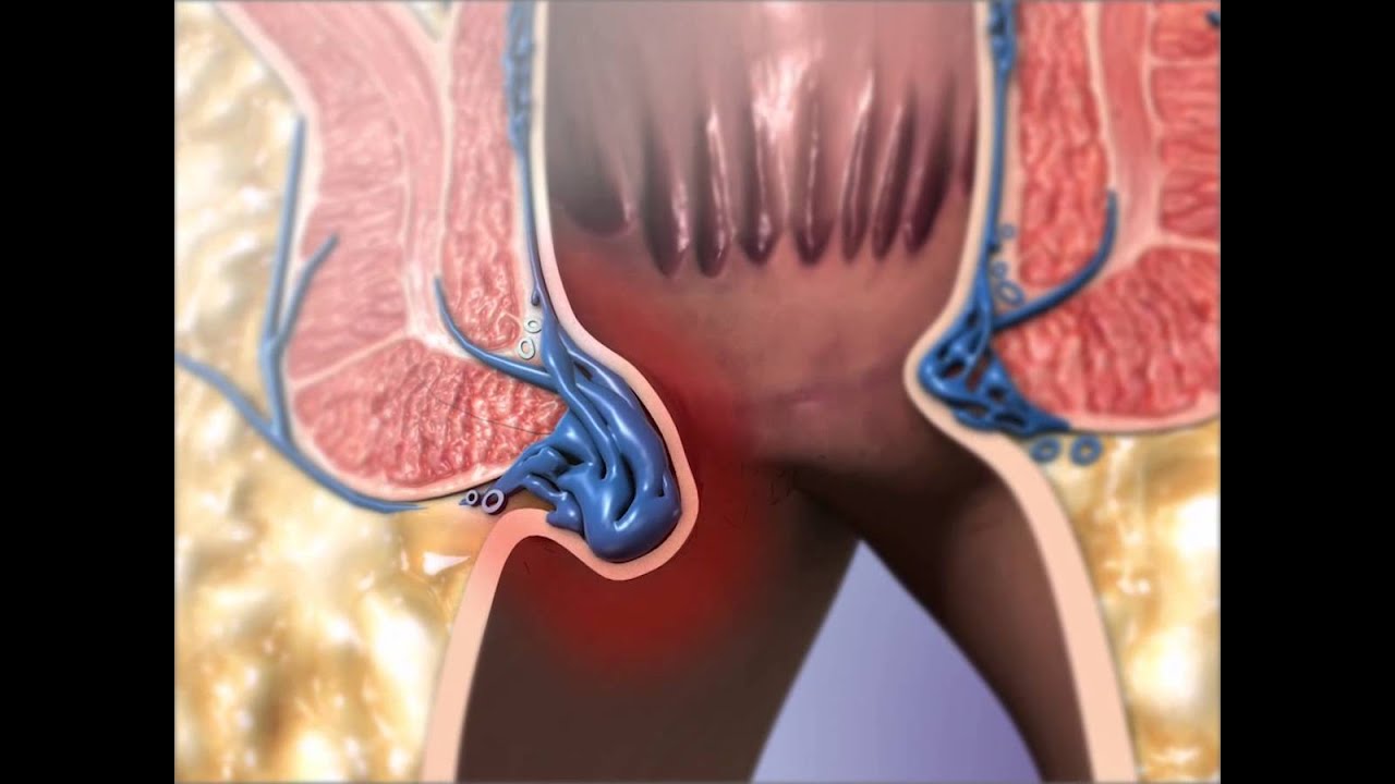 Можно Заниматься Анальным Сексом После Геморроя