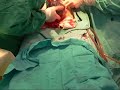 Imagen del vídeo Parto por cesarea by Eduardo Lemos 2008