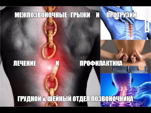 Как лечить межпозвоночную грыжу грудного отдела Как лечить межпозвоночную грыжу грудного отдела