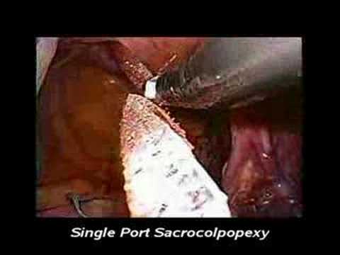 laparoscopic hysterectomy.