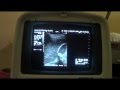 34 wk PREGNANCY with GB and RK pathologies