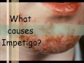 What Is Impetigo?