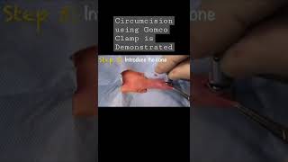 How To Do Circision Using Gomco Clamp? Step By Step Guide.