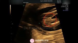 15 haftada ultrasonda kız bebek nasıl görünür? Hata? Bacak arası alttan bakış, dış ve iç dudaklar.