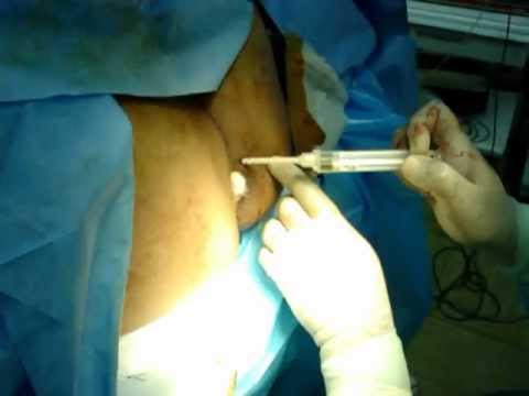 glueing anal fissures pale skin girl porn hot