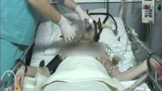 Ect Remedy 2