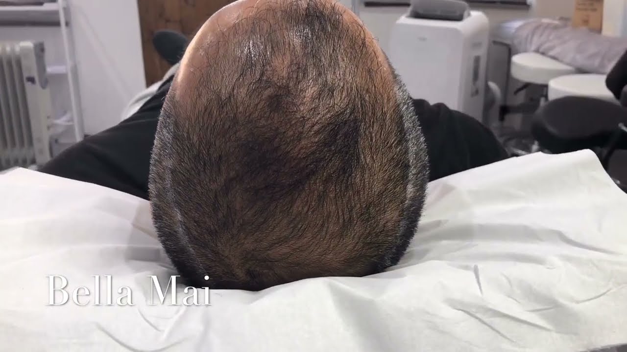 Scalp Micropigmentation Videos