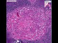 Histopathology Lymph node --Tuberculosis