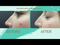 Non Surgical Nose Job - "Liquid Rhino" - The Park Clinic for Plastic Surgery