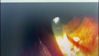 Removal Of A Bubble Of Pfcl In The Anterior Chamber Using A Slit Lamp Outside The Operating Room
