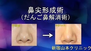 鼻尖軟骨縛り(団子鼻修正) 山本クリニック