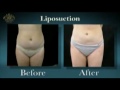 Orlando liposuction Dr. Brian Joseph