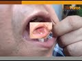 Severe Oral Lichen Planus