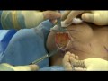 Breast implants scar capsule removal