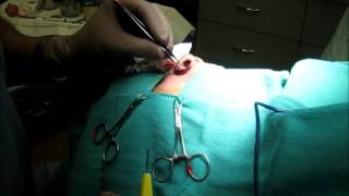 Alar Base Resection