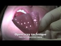 Dental Implant - Impression and Insertion of crown