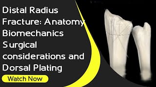 Distal Radius Fracture Anatomy Biomechanics Surgical Considerations And Dorsal Plating