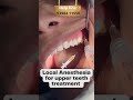 Local Anesthesia For Upper Teeth Treatment || Happy Smiles Dental Care || #shorts