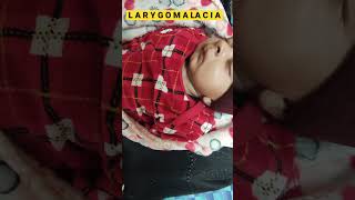 Laryngomalacia