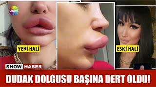 Dudak dolgusu başına dert oldu!