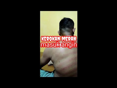 KEROKAN MERAH AKIBAT MASUK  ANGIN.