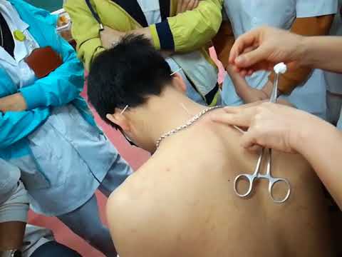 Châm cứu vùng vai gáy YHCTYDTN 2018