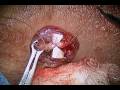 Mini Incision No-Scalpel Vasectomy Reversal from California Vasectomy & Reversal Center